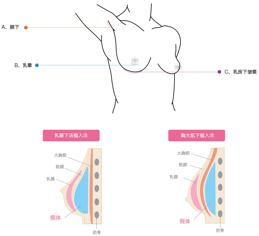 假体丰胸手术方法图解