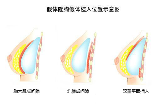 假体隆胸假体放置位置图示