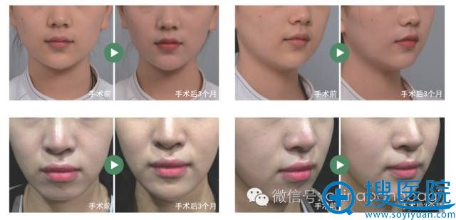 韩国巴诺巴奇皮肤科v-line提升前后对比案例图片