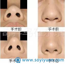 中北信昭鼻部整形案例对比图片