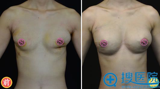 瘢痕松解+脂肪移植胸部修复案例