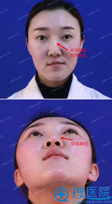 刚在上海美莱医院找李保锴做隆鼻修复手术1个月妹子的亲身经历