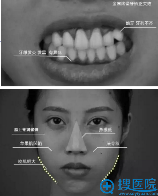 术前检查：龅牙+面部一系列问题