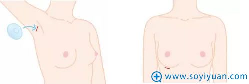 日本假体隆胸手术切口示意图
