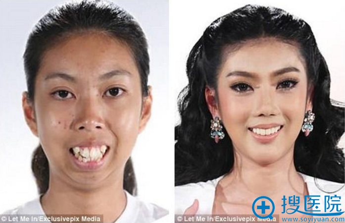 泰国龅牙妹Punbu龅牙矫正与下巴手术前后对比照片