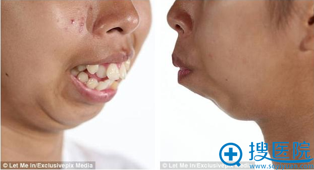 泰国妹Punbu手术前龅牙情况比较严重 下巴也后缩