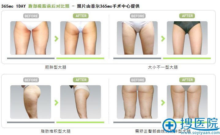 韩国首尔365mc医院大腿吸脂前后对比案例