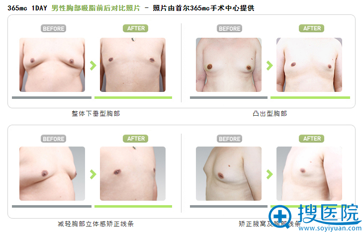 韩国首尔365mc医院男性胸部吸脂前后对比案例