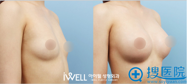韩国爱我整形医院假体隆胸案例