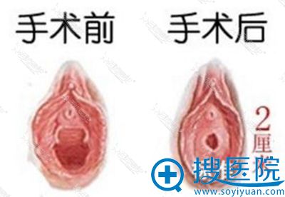 韩国好手艺妇科医院处女膜修复手术