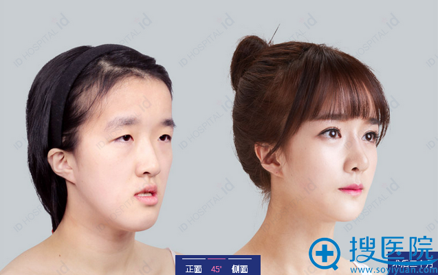 韩国ID整形医院隆鼻（芭比鼻整形）真人案例