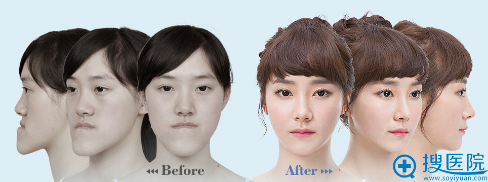 韩国id整形医院V-line下颌角手术案例