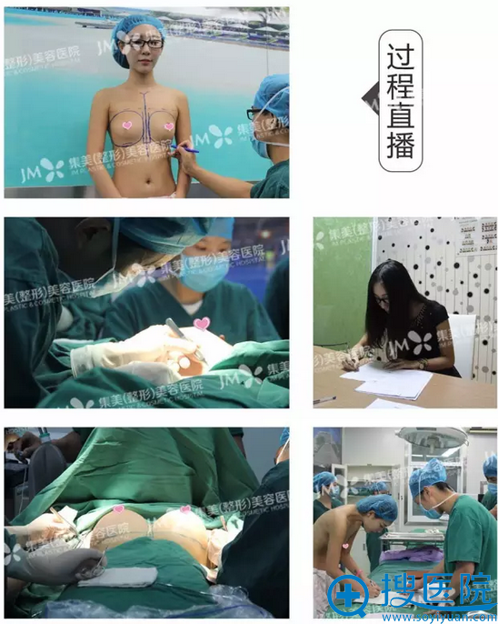 假体隆胸手术过程