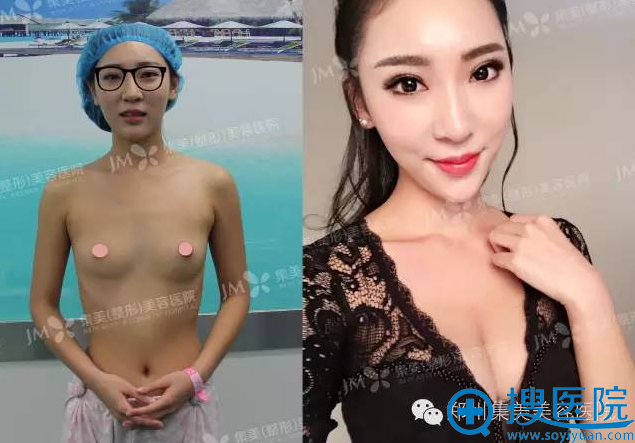 在郑州集美做假体隆胸前后对比图