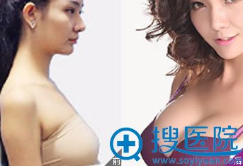 宁波尚美整形医院假体隆胸案例