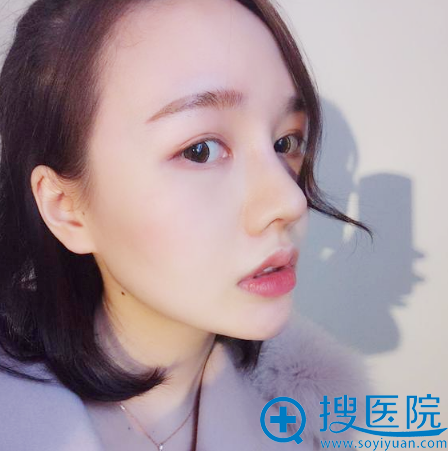 去上海薇琳医美找顾陆健做完隆鼻两周恢复图片