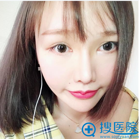 上海薇琳医美顾陆健隆鼻案例术后两个月图片