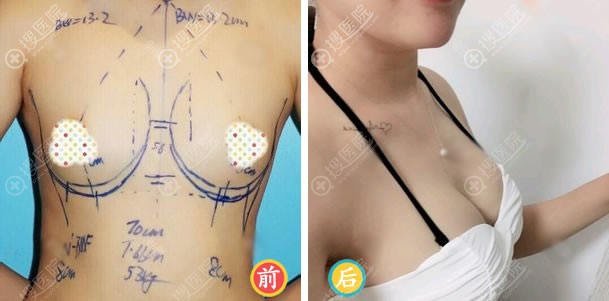 北京协和曾昂傲诺拉假体隆胸案例