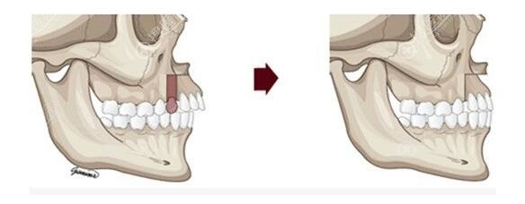 正颌手术示意图