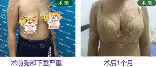 人工韧带乳房悬吊术对比效果图