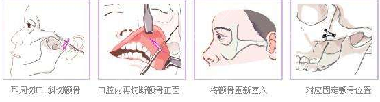 颧骨手术过程图