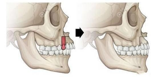 骨性凸嘴做正颌手术改善手术过程图