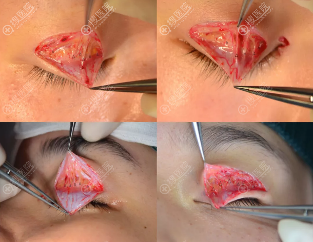 保留血管双眼皮手术过程图