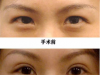 韩式三点定位双眼皮手术