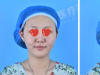 洛阳安和瘦脸真实案例:全面部线雕＋玻尿酸填充轻松打造小V脸