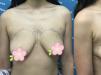 天生乳房松弛下垂该怎么办,北京哪个医生做胸部矫正比较好？