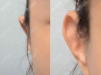 贴发耳矫正手术大概多少钱？顺带了解下耳朵往后贴的矫正方法