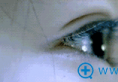 双眼皮手术失败怎么办 武汉五洲整形双眼皮修复手术效果好么