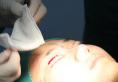 假体隆鼻恢复过程实例 河南整形医院支凌翔主任鼻整形案例