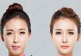 韩国双鄂手术大概多少钱？ID整形10万打造美丽脸型案例图