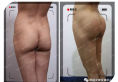 韩国女神整形医院案例 看臀部整形90天前后丰臀对比效果怎么样