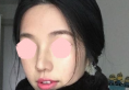 记录短塌鼻女孩在广州时光整形医院做鼻综合恢复期照片