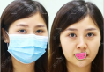 小姐姐在重庆当代找牙祖蒙做面部线雕拯救早衰初老脸的真实图片
