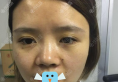 看了同学在深圳仁安雅做的双眼皮，我找苗春来做了鼻综合手术