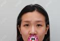 到韩国艾恩找金尹镐做了双眼皮隆鼻后气质和颜值都得到了提升