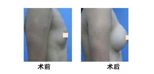 乳房再造手术费用是多少