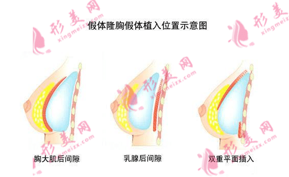 假体隆胸多少钱？做假体隆胸需要注意什么?