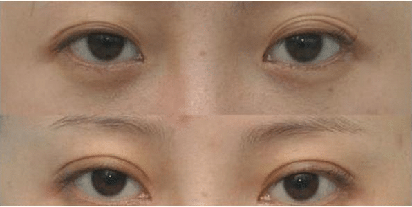 双眼皮失败的表现有哪些?双眼皮修复成功率高吗?