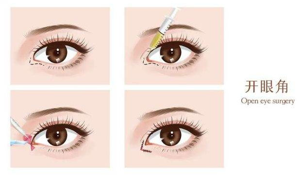 开内眼角有什么副作用，会留下疤痕吗？