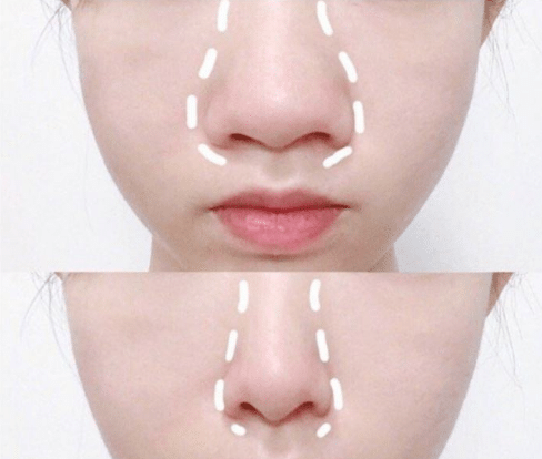 鼻头缩小有后遗症吗?鼻头缩小有哪些方法？