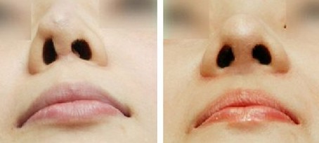 隆鼻修复手术优点有哪些
