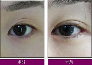 双眼皮修复有几种分类