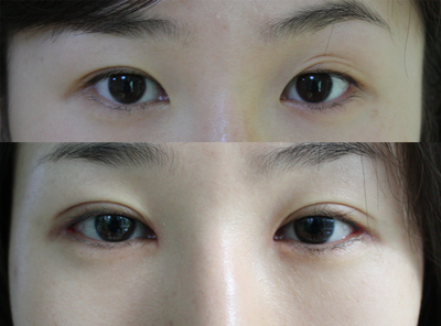修复双眼皮的方法有哪些