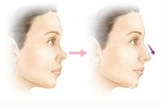 鼻部整形修复的方法有哪些