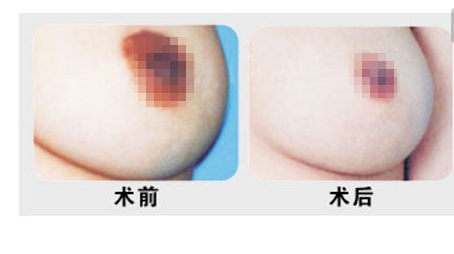 乳头缩小术效果怎么样