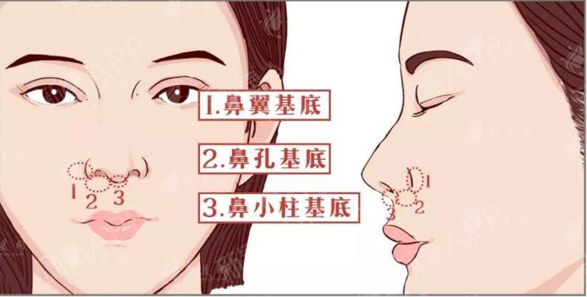 垫鼻基底的适应症状有哪些?